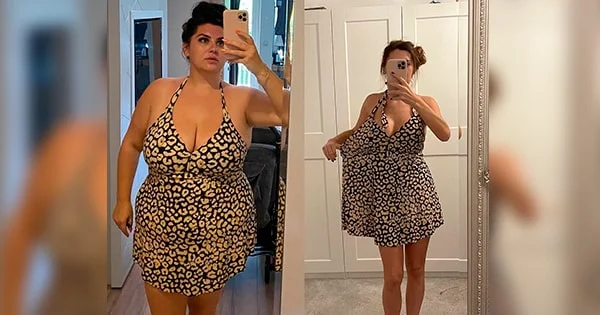 VittaBurn customer Marie before and after photos